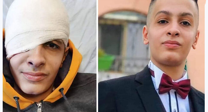 صیہونی فوج نے فلسطینی بچے کو آنکھ سے محروم کردیا