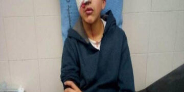 صہیونی فوج  کی گولی سے فلسطینی بچےکی آنکھ ضائع