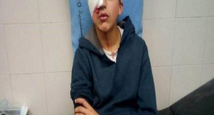 صہیونی فوج  کی گولی سے فلسطینی بچےکی آنکھ ضائع