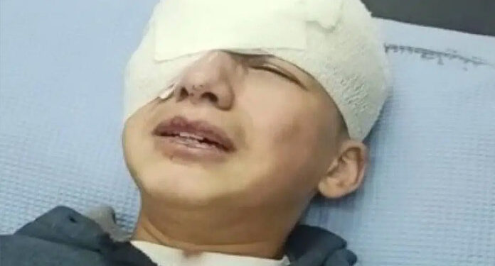 صیہونی فوج نے 13 سالہ بچے کو آنکھ سے محروم کردیا