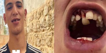 اسرائیلی بربریت: فلسطینی نوجوان کے دانت توڑ ڈالے