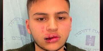 صہیونی آبادکاروں کا فلسطینی نوجوان پروحشیانہ تشدد، جسم کی کئی ہڈیاں توڑدیں